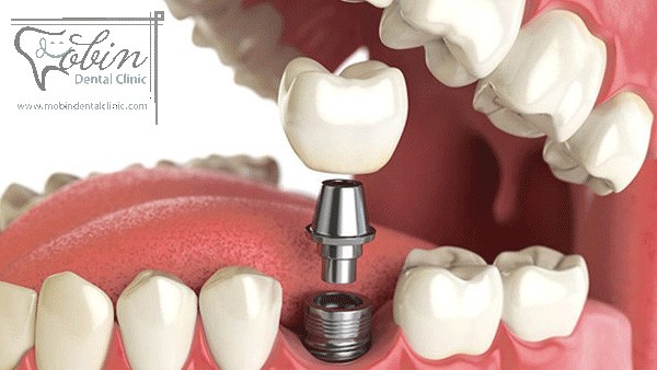 مزایا ایمپلنت دندان نسبت به سایر روش ها